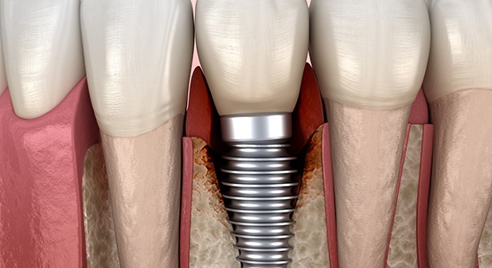 Illustration showing infected bone around a dental implant